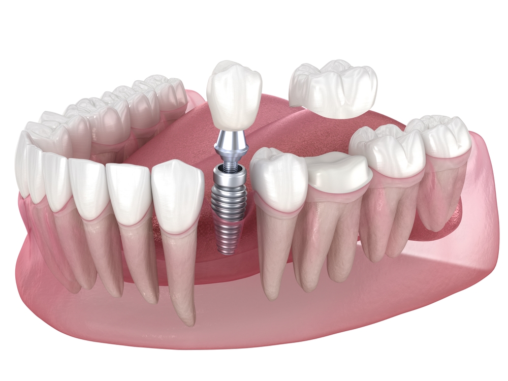 Dental,Implant,And,Ceramic,Crown.,Medically,Accurate,Tooth,3d,Illustration. Dental,Implant,And,Ceramic,Crown.,Medically,Accurate,Tooth,3d,Illustration.