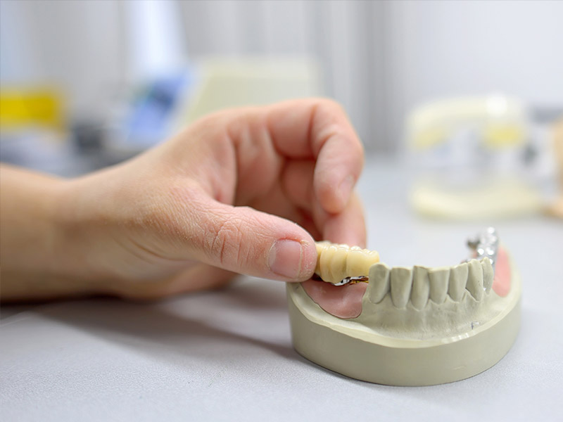 dental bridge edmonton dental bridge edmonton