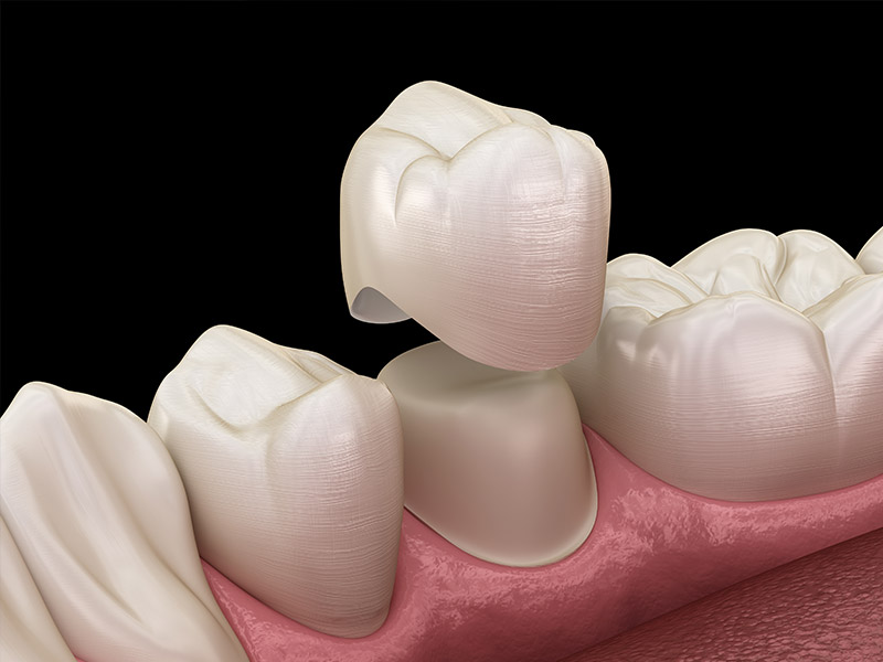 dental crown edmonton dental crown edmonton