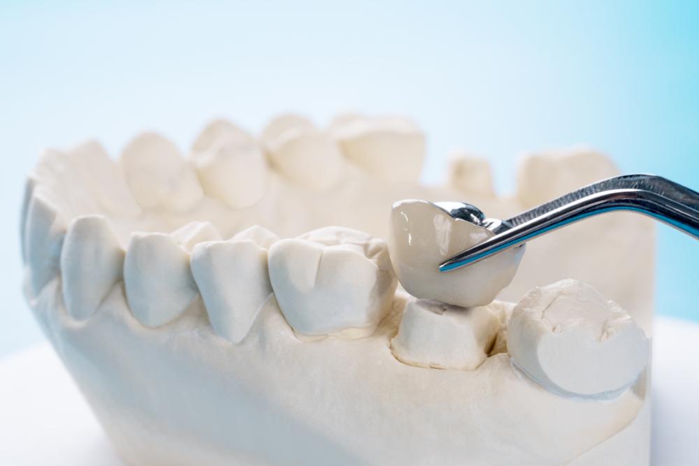 dental crowns near you