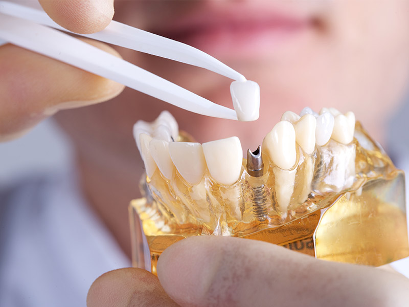 dental implant edmonton dental implant edmonton