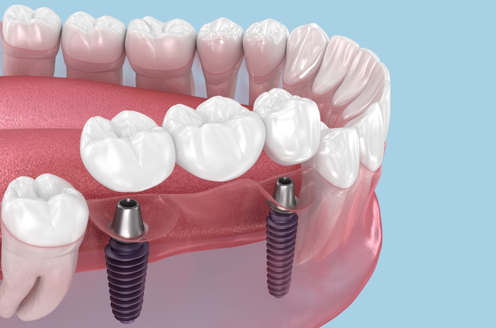 Dental,Bridge,Based,On,Two,Implants.,Medically,Accurate,3d,Illustration