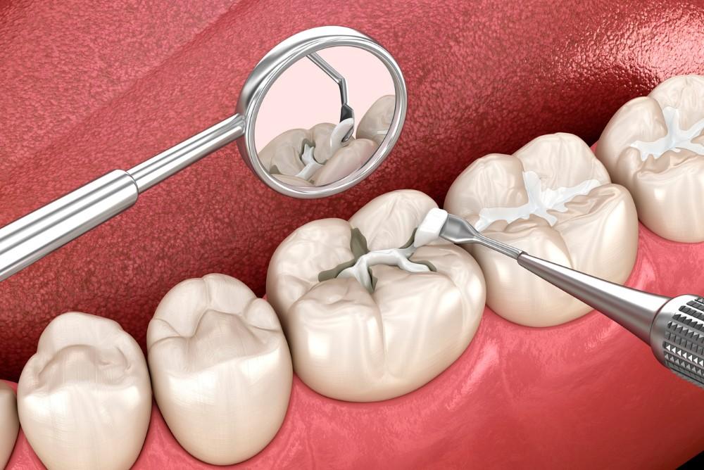 dental-sealants-in-edmonton dental-sealants-in-edmonton