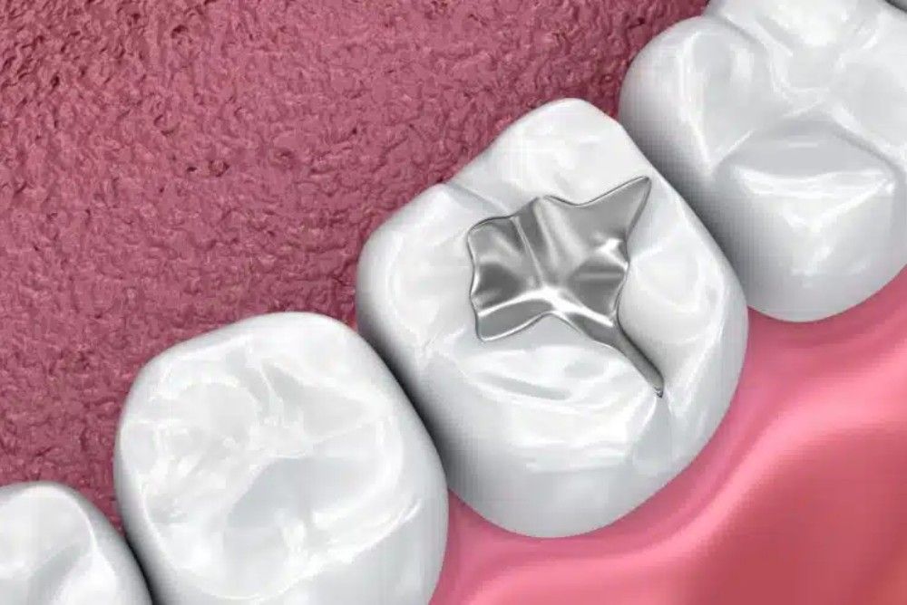 how-dental-sealants-in-edmonton-are-applies how-dental-sealants-in-edmonton-are-applies