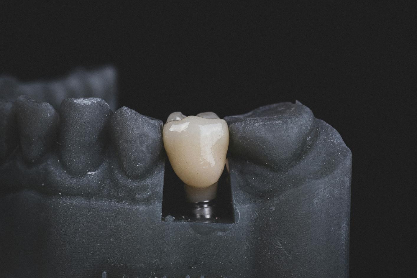 types of dental crowns in edmonton types of dental crowns in edmonton