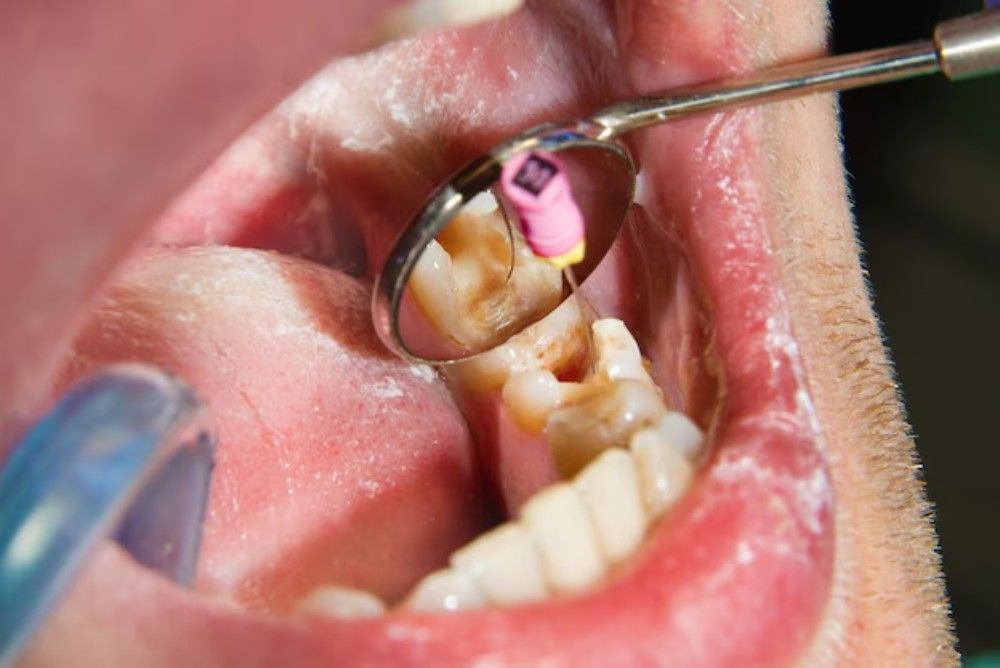 types-of-dental-fillings-in-edmonton types-of-dental-fillings-in-edmonton