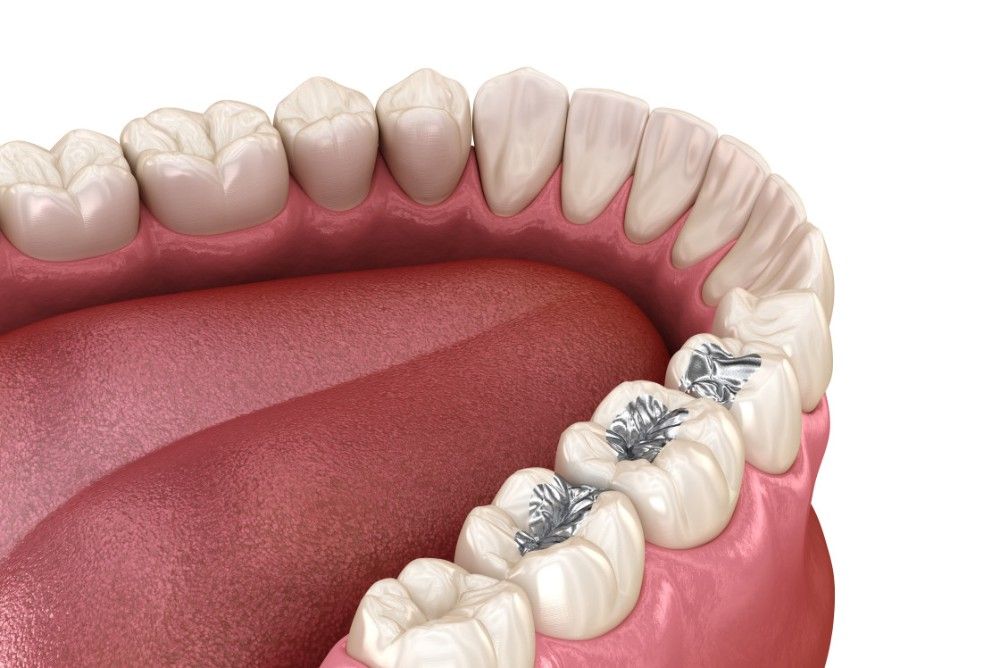 what-are-dental-sealants-near-you what-are-dental-sealants-near-you