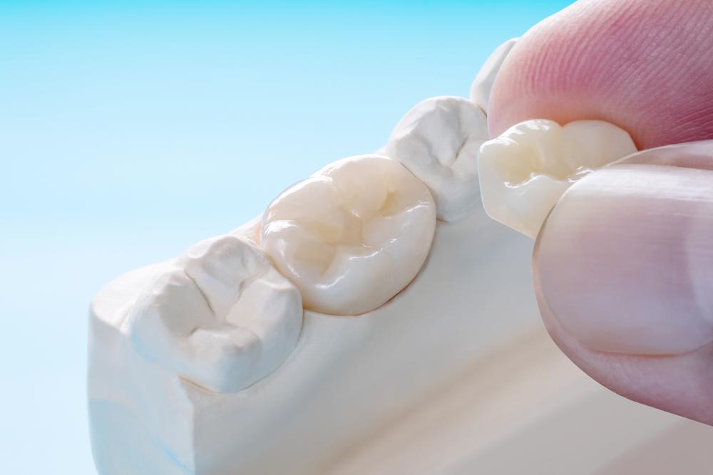 why choose allendale dental for dental crowns in edmonton why choose allendale dental for dental crowns in edmonton