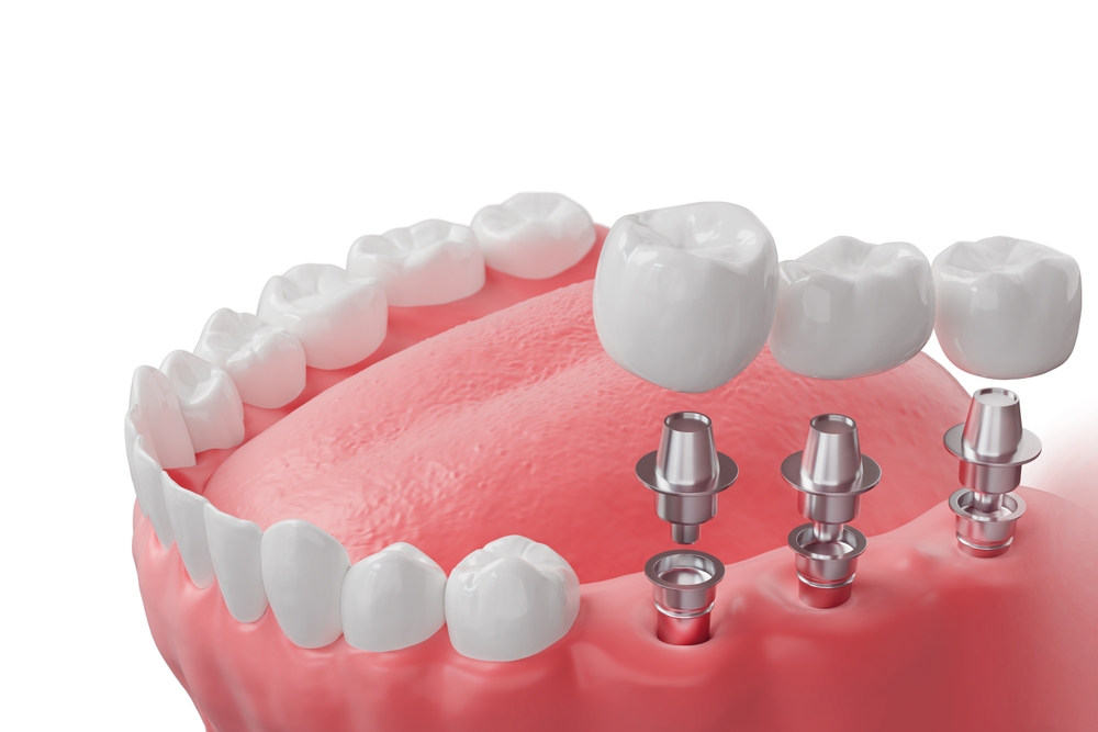 Closeup,White,Tooth,And,Gum,With,Dental,Implant,,,Human Closeup,White,Tooth,And,Gum,With,Dental,Implant,,,Human