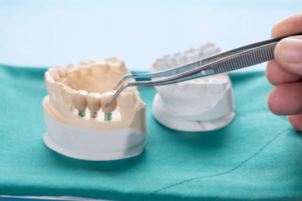 from-gaps-to-grins-the-power-of-dental-bridges