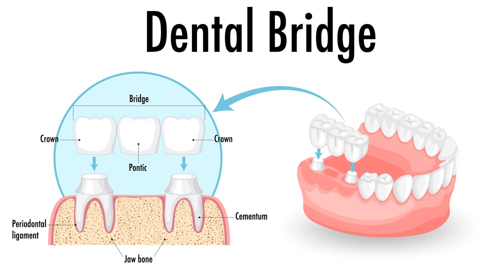 Can You Replace a Missing Tooth with a Dental Bridge?