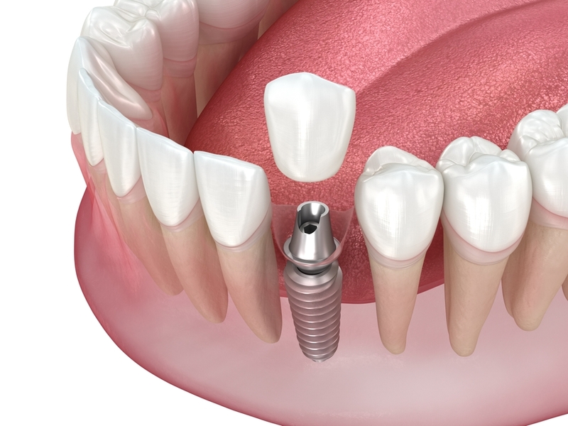is dental implant surgery painful what patients actually experience