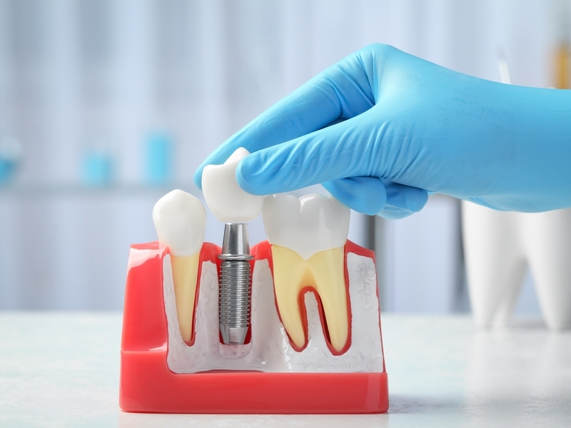 when should you replace a dental crown signs to watch